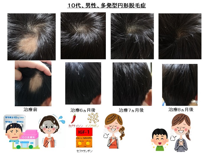 円形脱毛症　病院